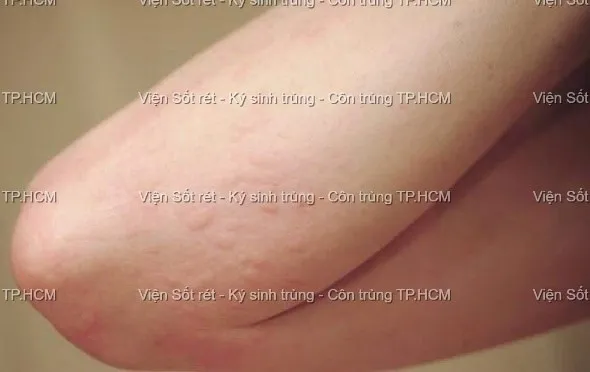 Các mảng đỏ dạng vòng xuất hiện dày đặc trên cơ thể người bệnh nhiễm giun chó mèo