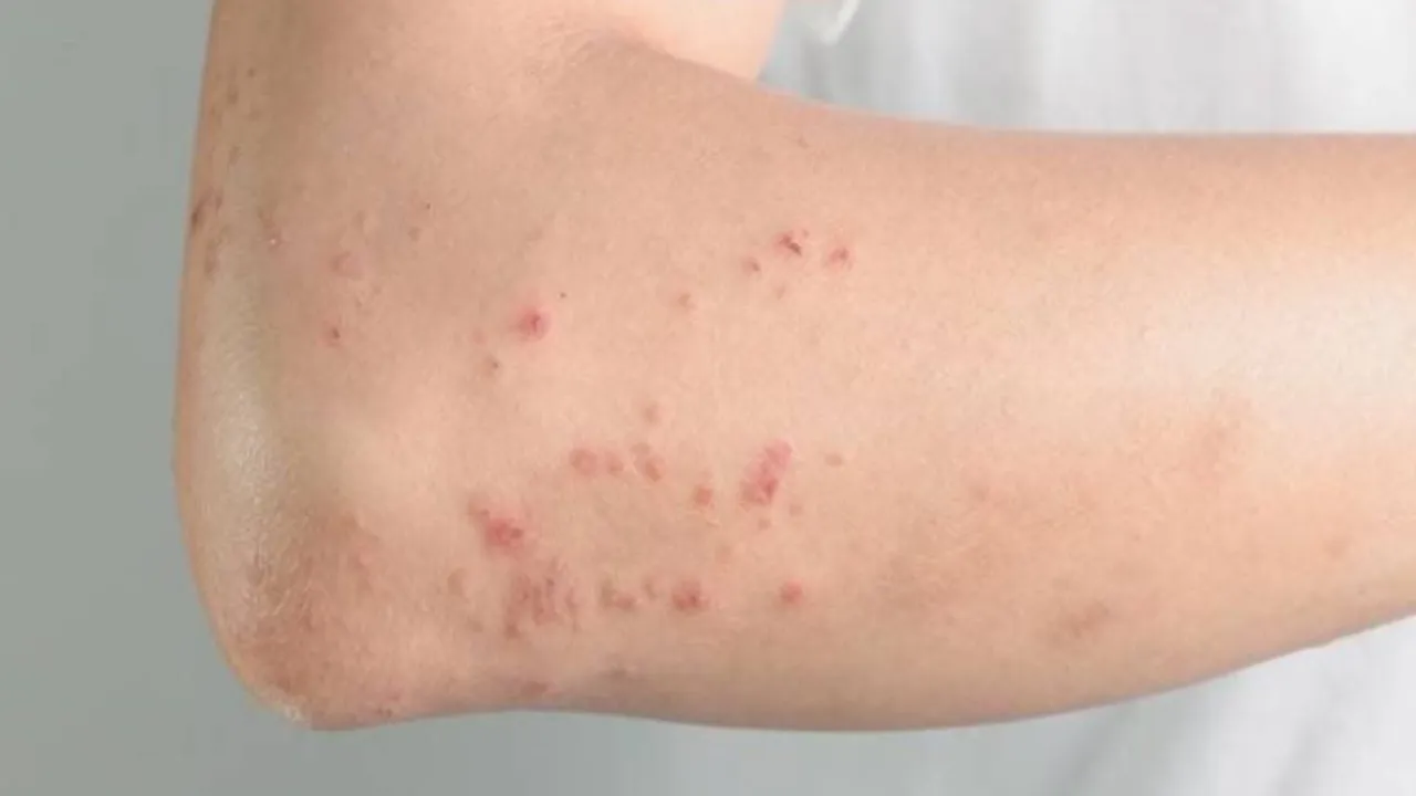 Bị Sán Chó Có Triệu Chứng Gì? Hướng Dẫn Nhận Biết Sớm